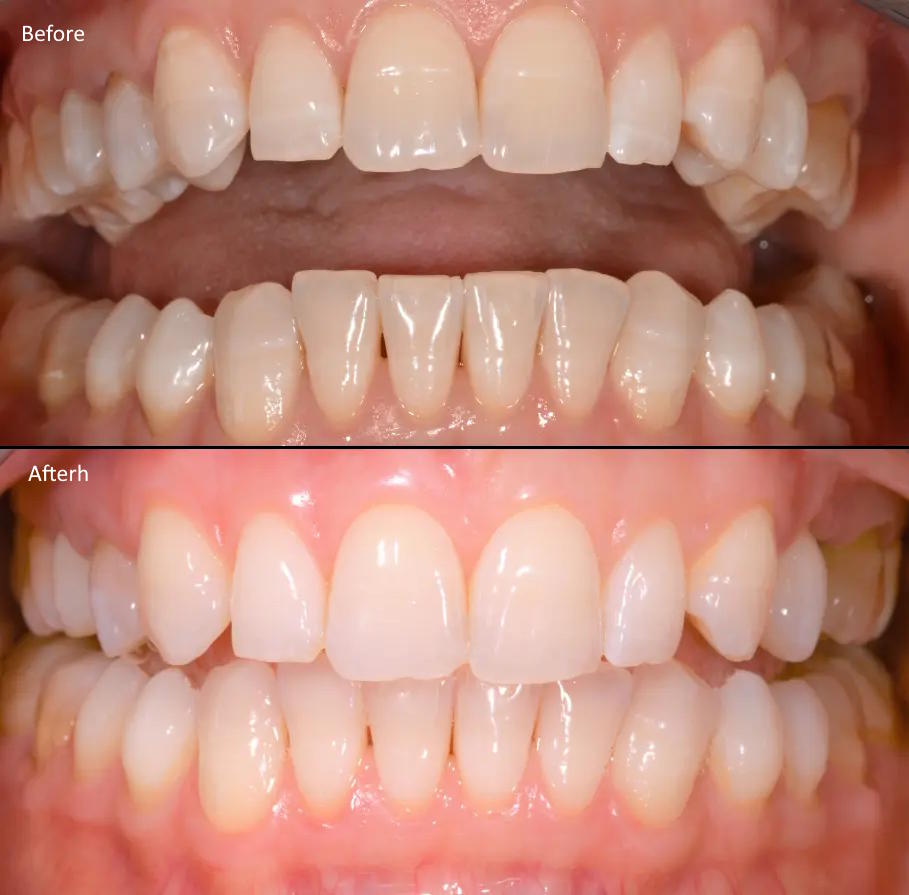Teeth whitening