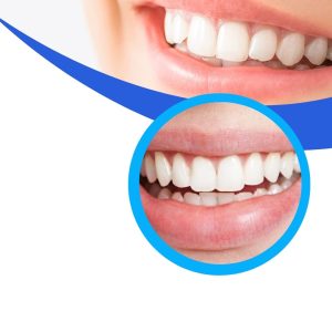 Teeth whitening